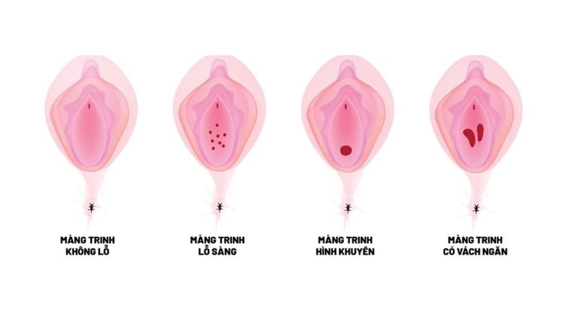 Tinh trùng vẫn có thể đi qua màng trinh