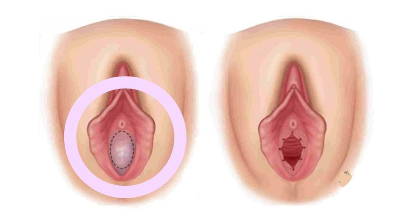 Chưa rách màng trinh có thai được không?